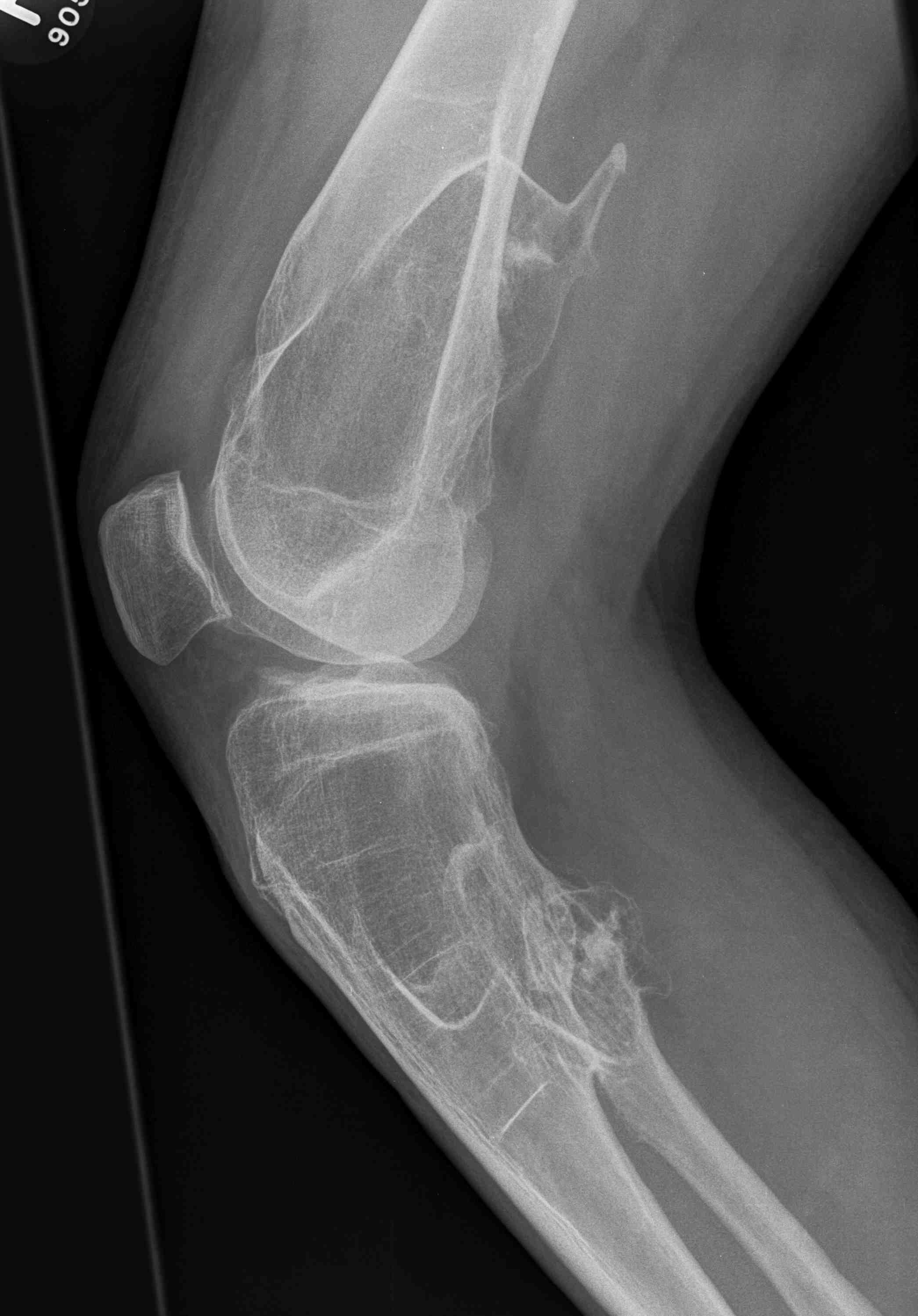 Osteochondroma Knee Lateral